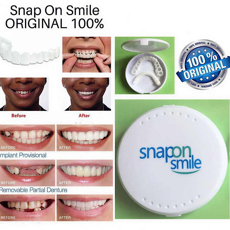 لمینت دندان دو فک مدل Snap on Smile
